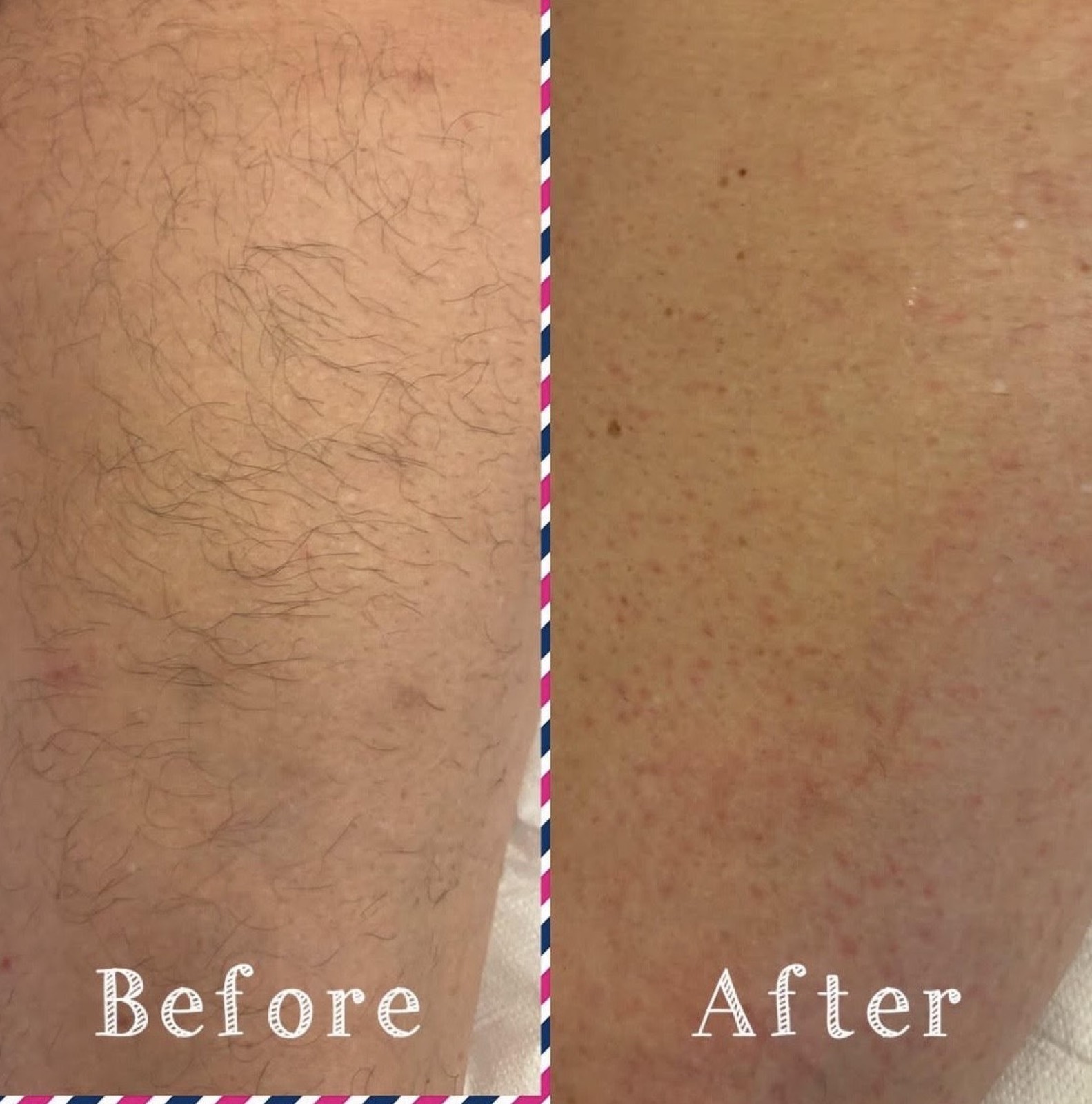 Thigh wax, before and after