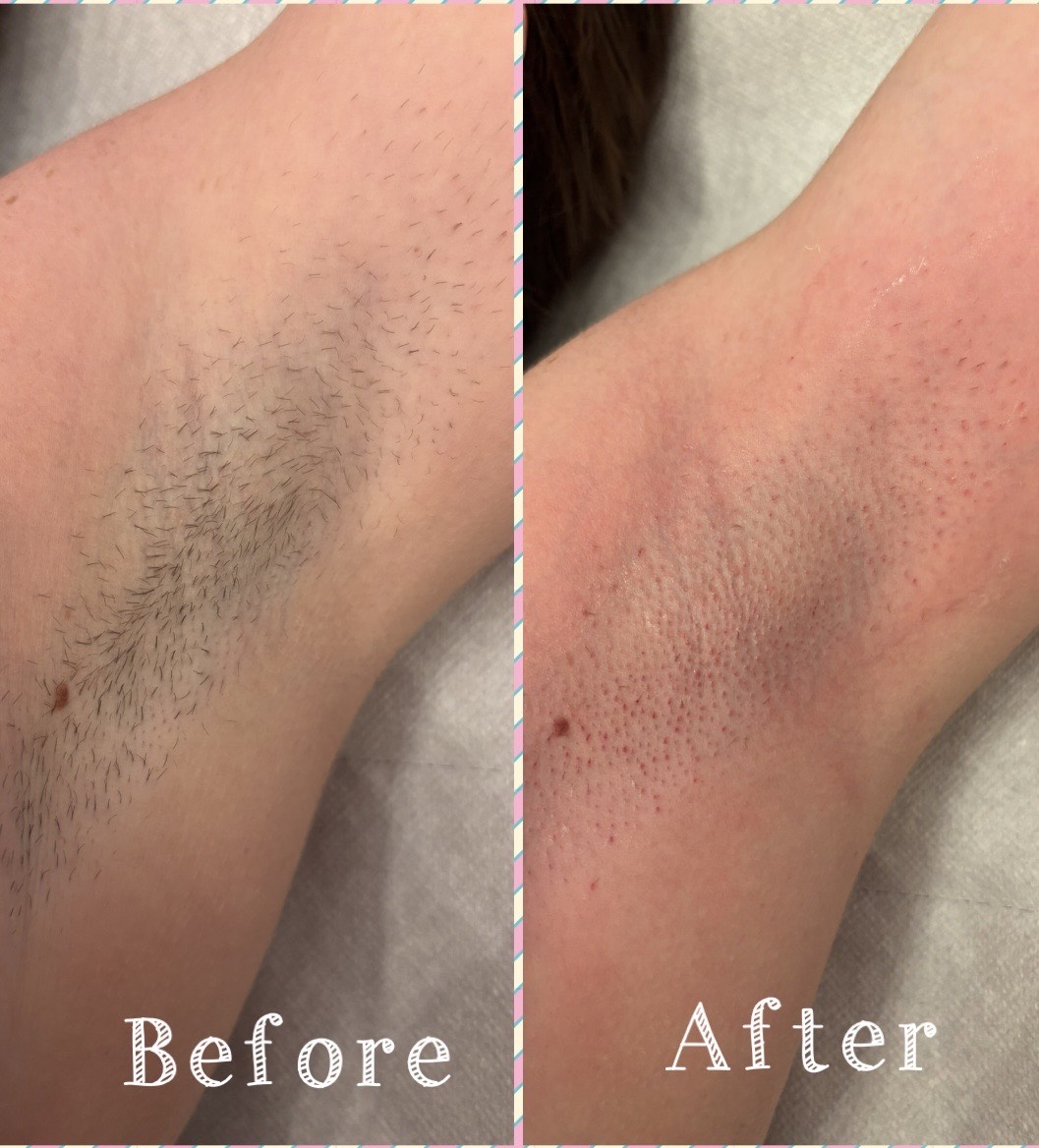 Underarm wax, before and after — a second client